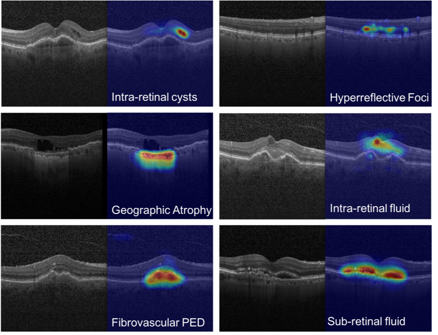 Various tomographic eye scans with biomarkers found by an AI system