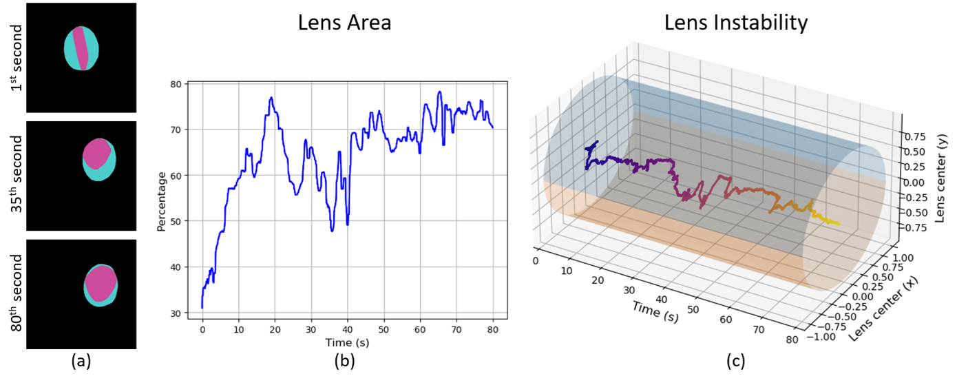 Darstellung einer Deep-learning-assisted intraocular lens irregularity detection während einer Katarakt-Operation